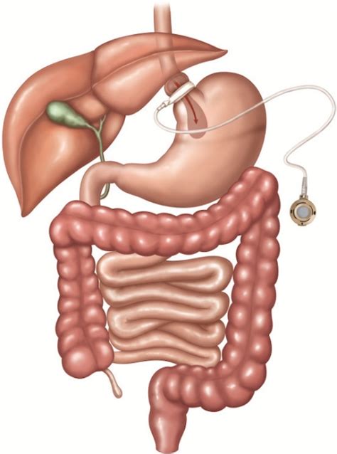 Bariatric Surgery The Operative Review Of Surgery