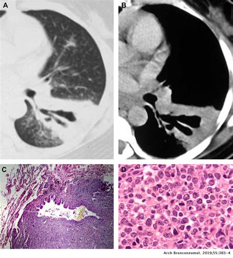 Dilated Air Bronchogram Inside Areas Of Consolidation A Tomographic