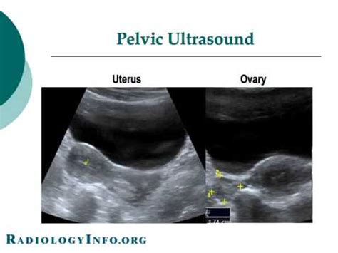 Pelvic Ultrasound: Pelvic Ultrasound Youtube