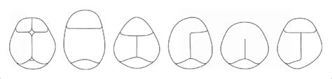 Craniosynostosis From Left To Right Normal Calvarial Sutures