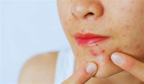 Chlamydia Rash On Face: Symptoms, Treatment And Causes