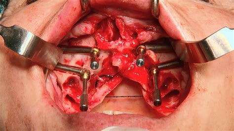 Quad Zygoma Surgery Jdentalcare