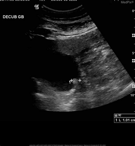 Gallbladder Polyps Ultrasound