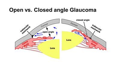 Angle-Closure-Glaucoma | eyesrus.com.au