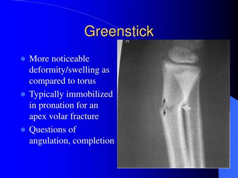 Ppt Pediatric Distal Radial Fractures Powerpoint Presentation Free