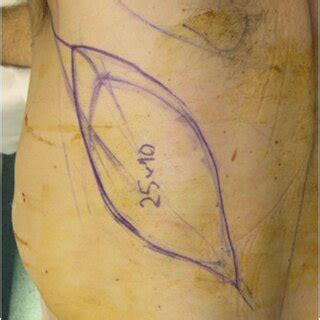 Free Latissimus Dorsi Muscle Only Flap Inset Into The Defect