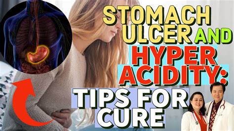 Stomach Ulcer And Hyperacidity Mabisang Lunas Tips By Doc Willie Ong