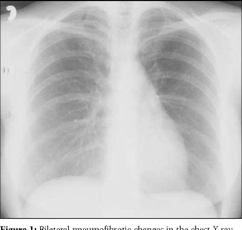 Figure 1 From Corticosteroid Responsive Pulmonary Toxicity Associated