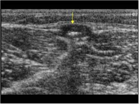 Calcification In The Veins