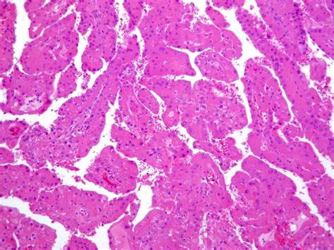 Pathology Outlines Papillary