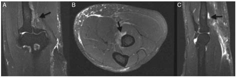 Scielo Brasil Acute Distal Biceps Ruptures Single Incision Repair By Use Of Suture Anchors