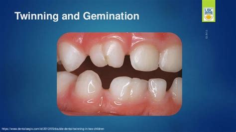 Supernumerary Teeth