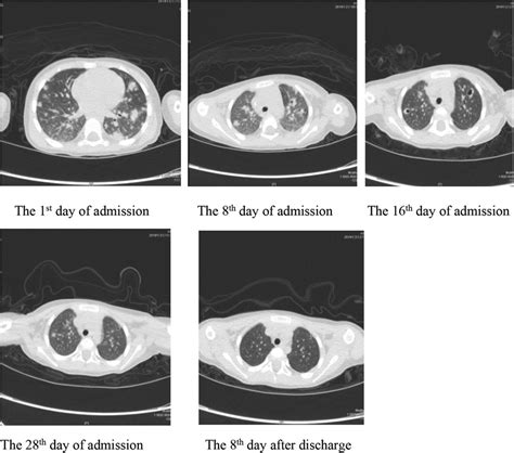 Frontiers Necrotizing Pneumonia And Purulent Meningitis Caused By