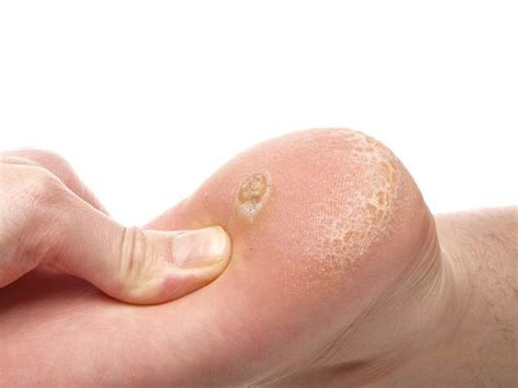 All About Plantar Warts