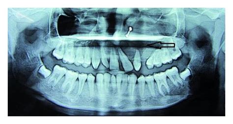 Orthopantomograph Showing Ill Defined Mixed Radiolucency In The Left