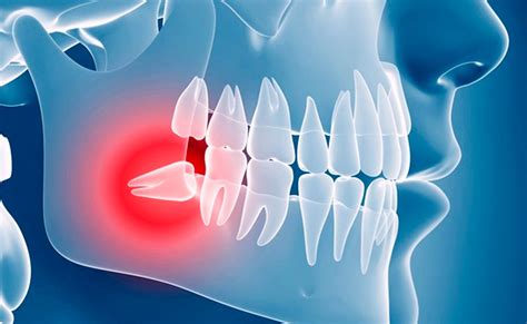 Muelas del Juicio Síntomas y tratamientos
