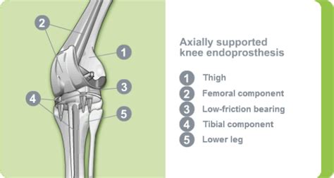 Artificial Knee Joint