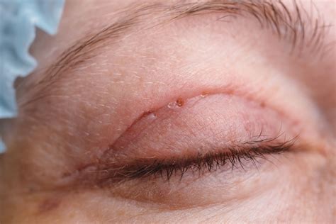 Eyelid Surgery Risks Sale Online Milwaukielumber