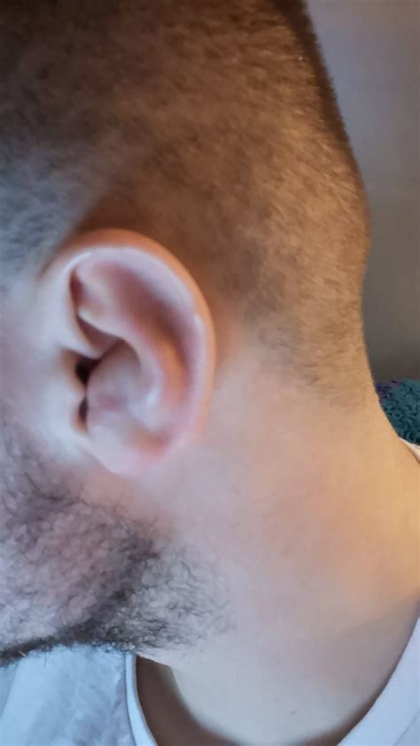 Advice On Cauliflower Ear R Bjj