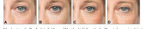 Figure 3 From Correction Of Tear Trough Deformity With A Cohesive