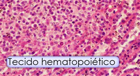 Tecido Hematopoiético - Só Patologias: Patologias do Tecido hematopoiético