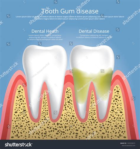 Human Teeth Stages Gum Disease Vector Stock Vector Royalty Free