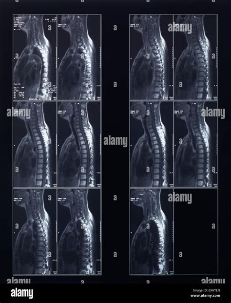 X-ray spine and neck radiography Stock Photo - Alamy