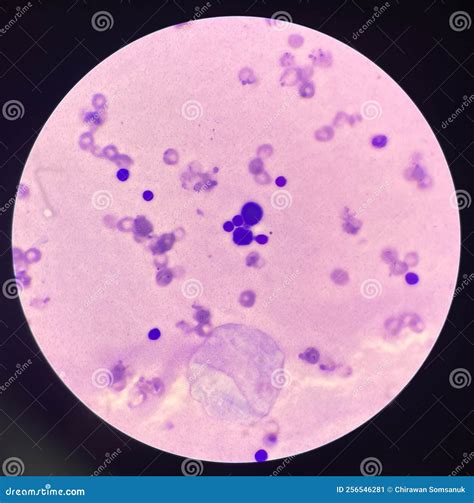 Abnormal Cells In Pleural Fluid Royalty Free Stock Image