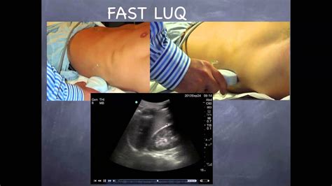 Tutorial Focused Assessment With Sonography In Trauma Youtube