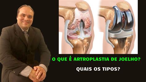 O que é Artroplastia de Joelho e quais os tipos YouTube