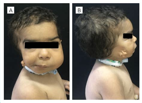 Craniofacial Dysmorphisms Observed In The Infant A Asymmetric