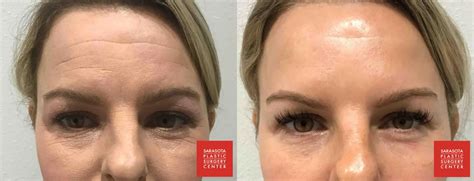 Botox Cosmetic Before After Gallery