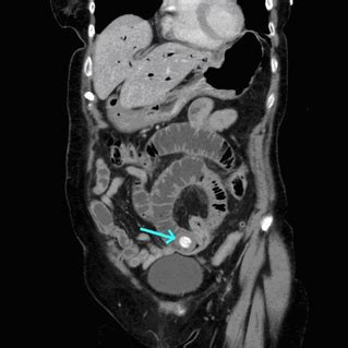 Gallstone ileus: a seldom cause of mechanical bowel obstruction ...