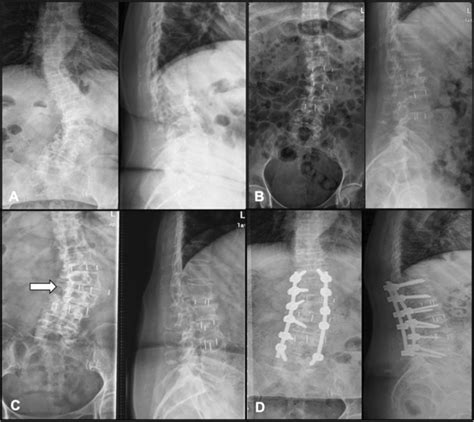 Postoperative A P And Lateral Fluoroscopy A The Preoperative