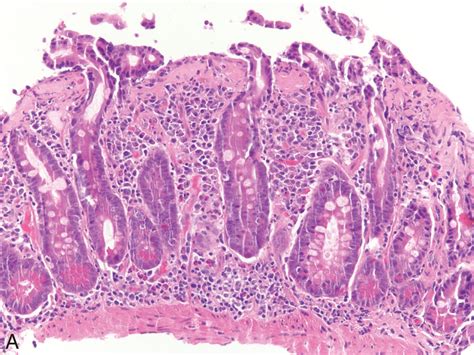 Non Neoplastic And Inflammatory Disorders Of The Small Bowel Clinical