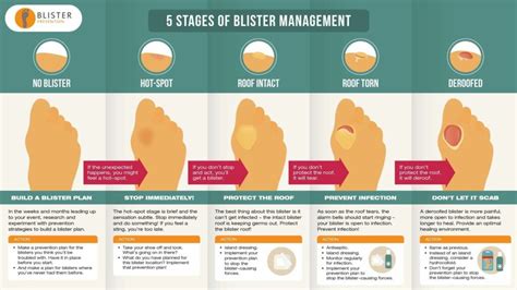 Hydrocolloids For Podiatrists and Our Patients - Blister Prevention Pro