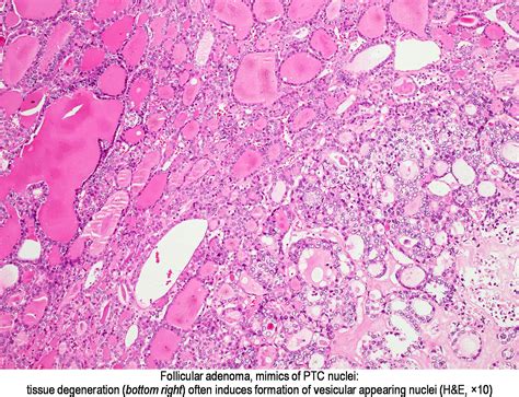 Pathology Outlines Follicular Adenoma