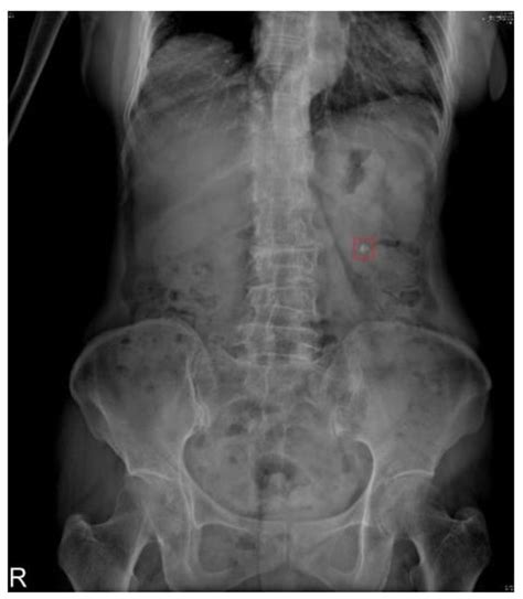 Struvite Kidney Stones Xray