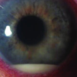 -Uveitis with hypopyon | Download Scientific Diagram