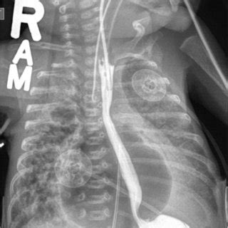 Portable Chest Radiographs Obtained On Day Of Life 8 In Anteroposterior