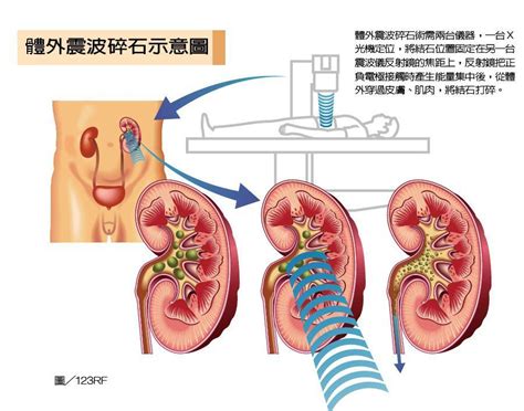 發現結石怎麼辦？該選哪種手術處理？泌尿科醫師解析｜泌尿腎臟｜科別｜元氣網