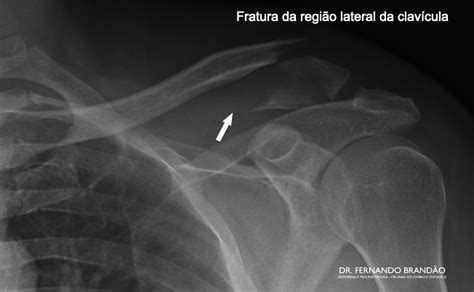 Quebrar A Clavícula É Grave - Fratura da clavícula: saiba tudo sobre a fratura mais comum do ombro