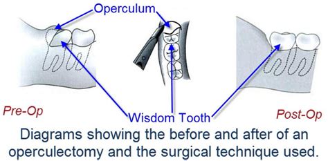 Operculectomy Exodontia