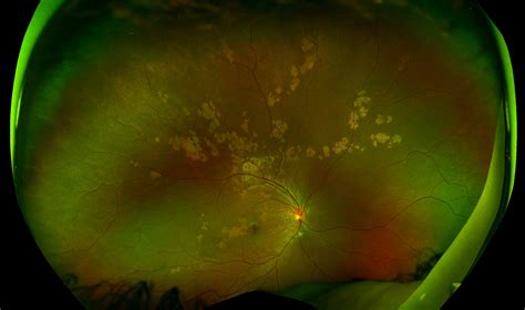 Ophthalmology Dx: Tracking the Cause of White Retinal Spots ...