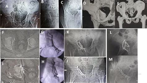 A 48 Year Old Male With Right Acetabular Fracture A F X Ray And Ct