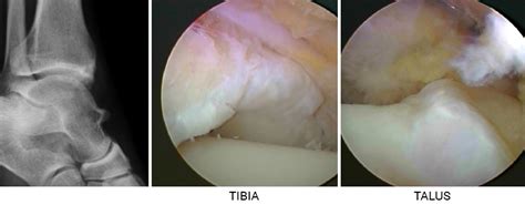 Anterior Arthroscopy | Peter Rosenfeld FRCS, London