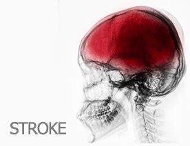 Post Stroke Recovery With Stem Cell Therapy Swiss Medica