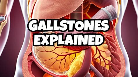 Understanding Gallstones Causes Symptoms And Treatment Gallstones Healthcare Nutrition