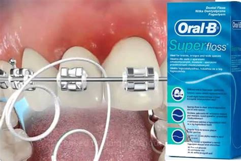 Hilo Dental Especial Para Brackets Como Se Usa Ortodoncia Gum