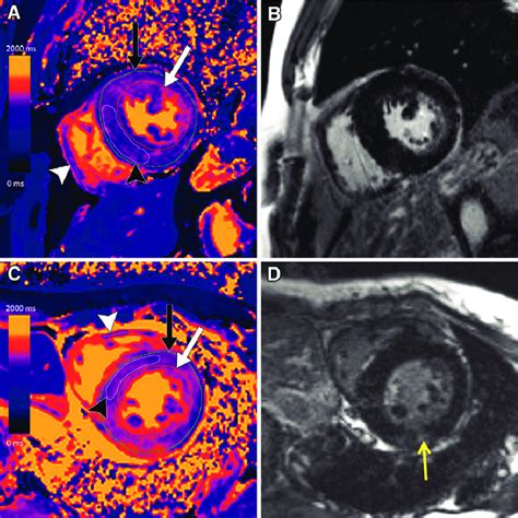 A C Short Axis Native T1 Maps And B D Corresponding Late